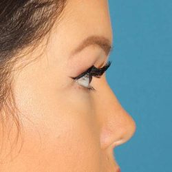 Browlift Before & After Patient #1384