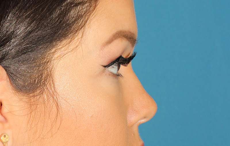 Browlift Before & After Patient #1384