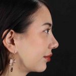 Rhinoplasty Before & After Patient #3159