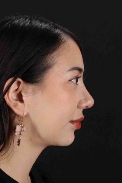 Rhinoplasty Before & After Patient #3159