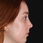 Rhinoplasty Before & After Patient #3170