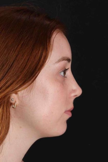 Rhinoplasty Before & After Patient #3170