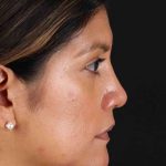 Rhinoplasty Before & After Patient #3181