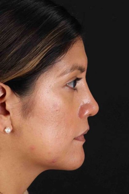 Rhinoplasty Before & After Patient #3181