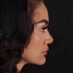 Rhinoplasty Before & After Patient #3192
