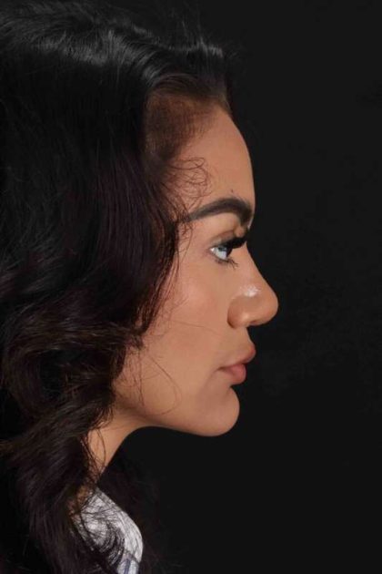 Rhinoplasty Before & After Patient #3192