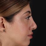 Rhinoplasty Before & After Patient #3214