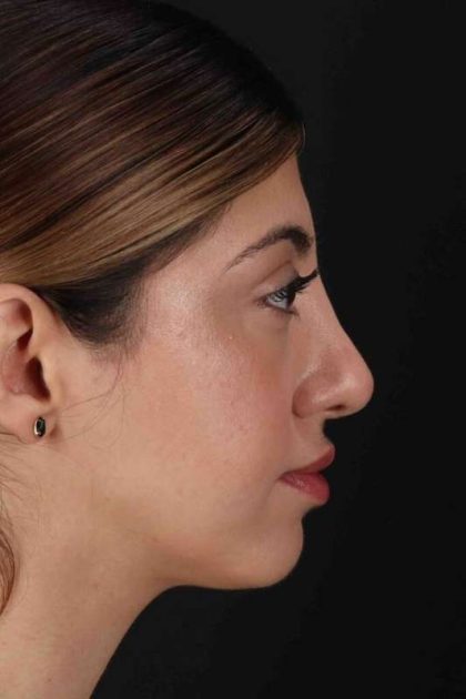 Rhinoplasty Before & After Patient #3214