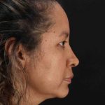 Rhinoplasty Before & After Patient #3225