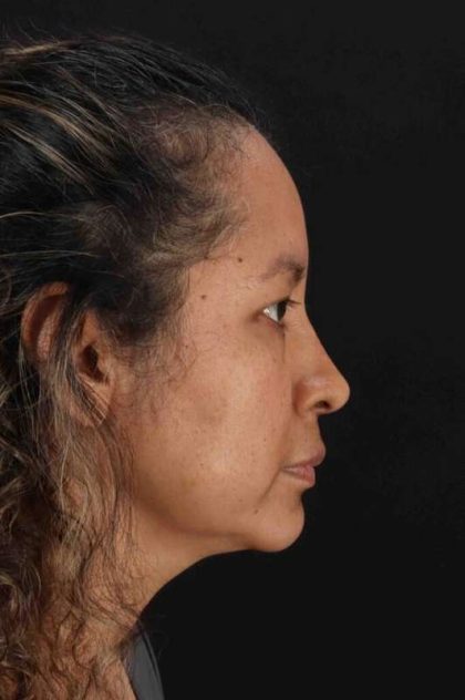 Rhinoplasty Before & After Patient #3225