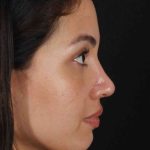 Rhinoplasty Before & After Patient #3236