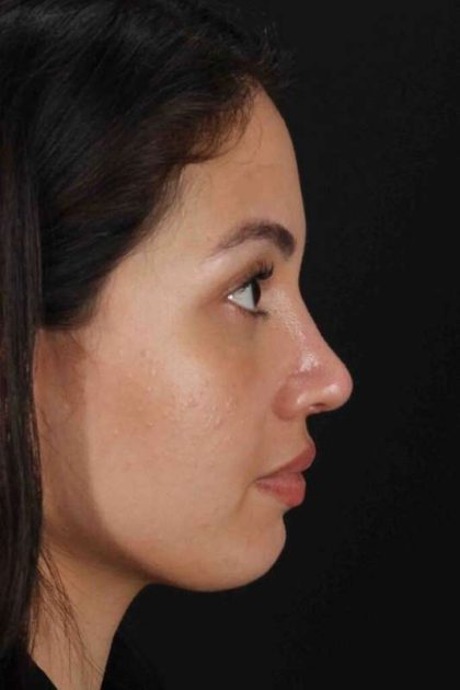 Rhinoplasty Before & After Patient #3236