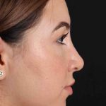 Rhinoplasty Before & After Patient #3247