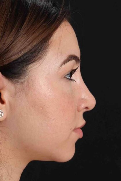 Rhinoplasty Before & After Patient #3247