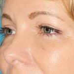 Browlift Before & After Patient #1391