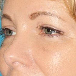 Browlift Before & After Patient #1391
