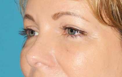 Browlift Before & After Patient #1391