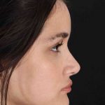 Rhinoplasty Before & After Patient #3258