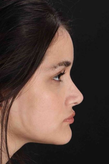 Rhinoplasty Before & After Patient #3258