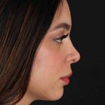 Rhinoplasty Before & After Patient #3269