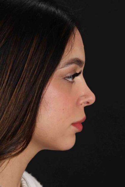 Rhinoplasty Before & After Patient #3269