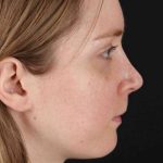 Rhinoplasty Before & After Patient #3280