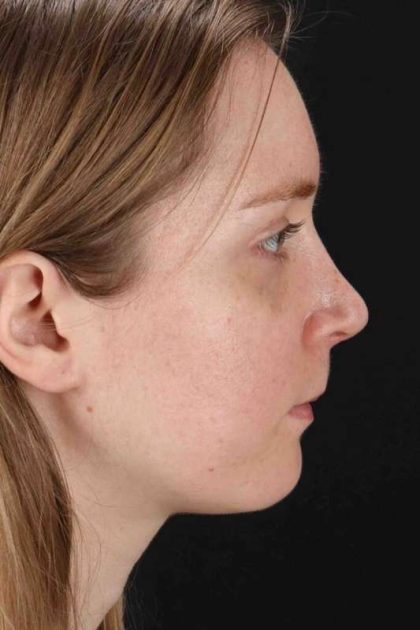 Rhinoplasty Before & After Patient #3280