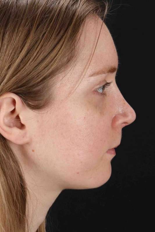Rhinoplasty Before & After Patient #3280