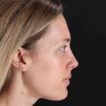 Rhinoplasty Before & After Patient #3291