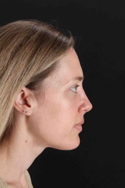 Rhinoplasty Before & After Patient #3291