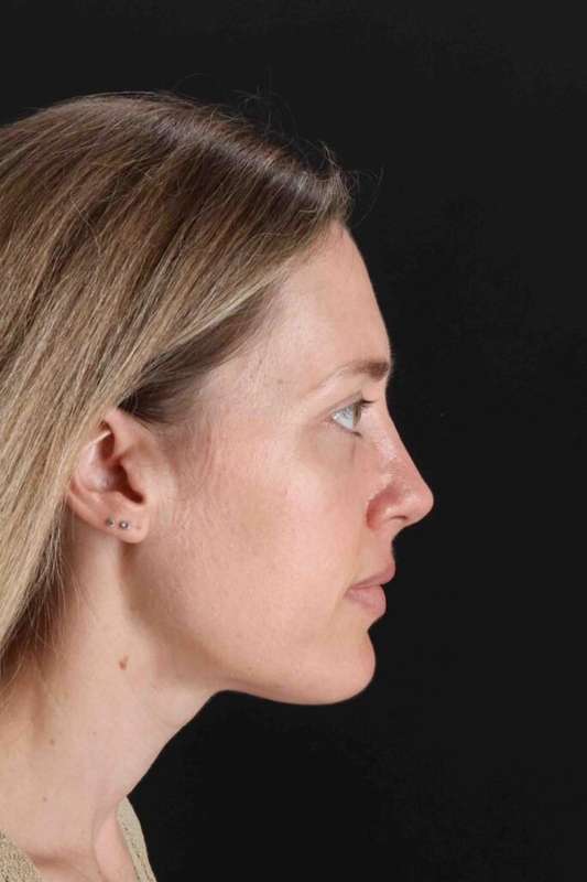Rhinoplasty Before & After Patient #3291