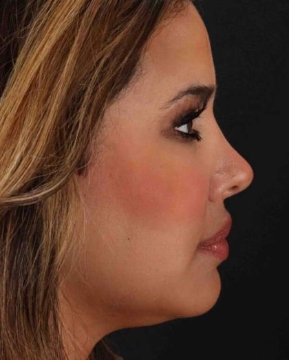 Rhinoplasty Before & After Patient #3324