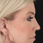 Co2 Laser Before & After Patient #3335