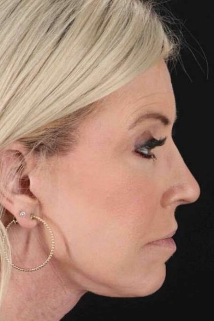 Co2 Laser Before & After Patient #3335