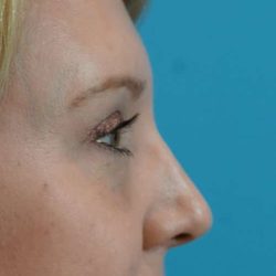 Browlift Before & After Patient #1402