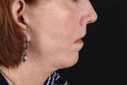 Submental Liposuction Before & After Patient #3401