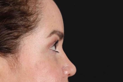 Upper Blepharoplasty Before & After Patient #3445