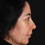 Upper Blepharoplasty Before & After Patient #3456