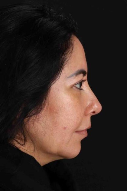 Upper Blepharoplasty Before & After Patient #3456