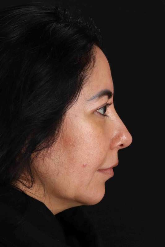 Upper Blepharoplasty Before & After Patient #3456