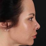 Buccal Fat Pad Before & After Patient #1425