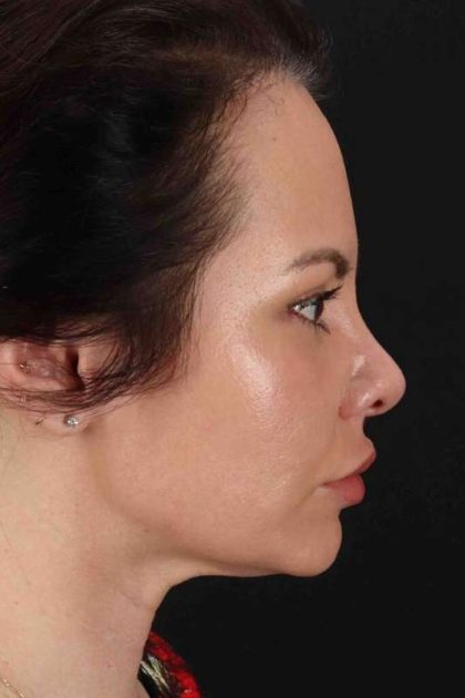 Buccal Fat Pad Before & After Patient #1425