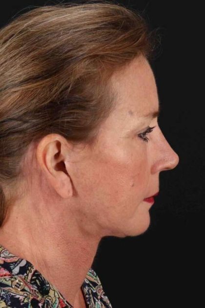 Upper Blepharoplasty Before & After Patient #3478