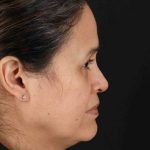 Upper Blepharoplasty Before & After Patient #3489