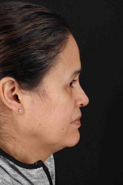Upper Blepharoplasty Before & After Patient #3489