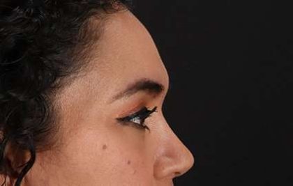 Upper Blepharoplasty Before & After Patient #3522