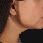 Facelift Before & After Patient #3555