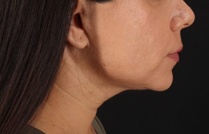 Facelift Before & After Patient #3555