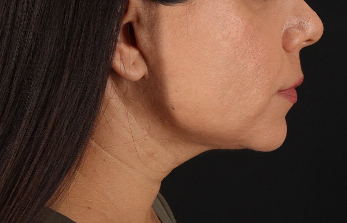 Facelift Before & After Patient #3555