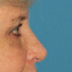 Lower Blepharoplasty Before & After Patient #2419